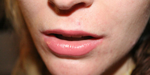 Why Are My Lips So Dry? Uncovering the Causes and Cures